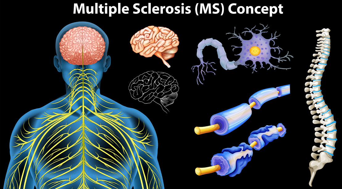 Multiple Sclerosis